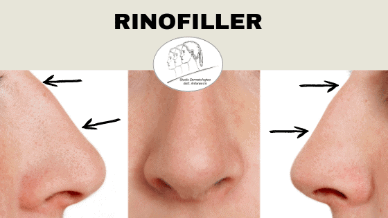trattamento rinofiller parma